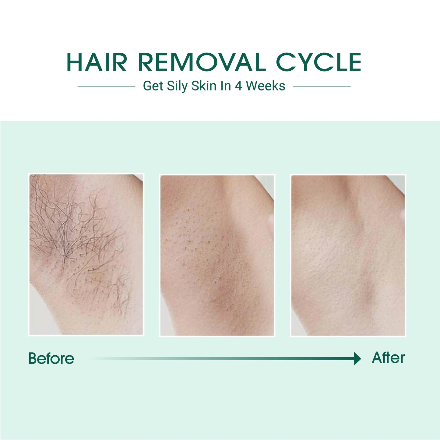 Hair Removal IPL Laser